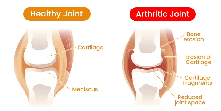 Educational comparison between a healthy and arthritic knee